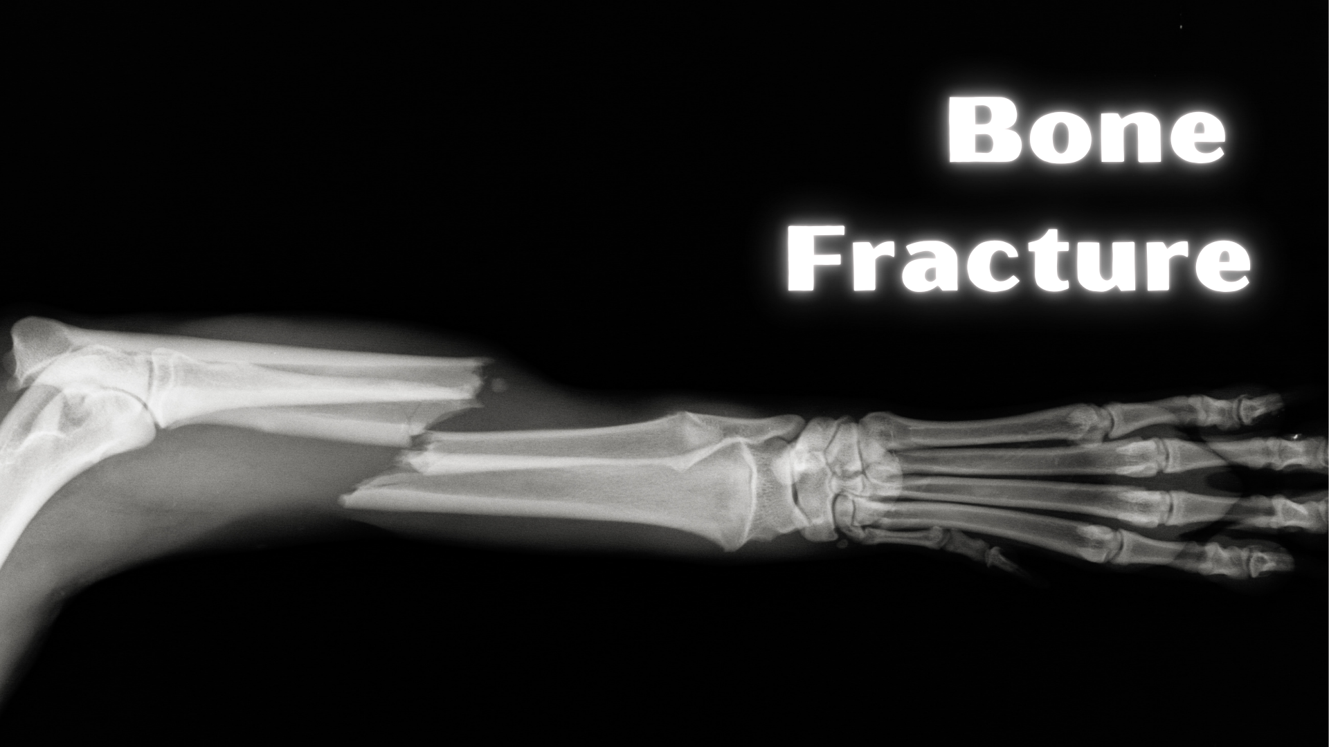 bone-fracture-classification